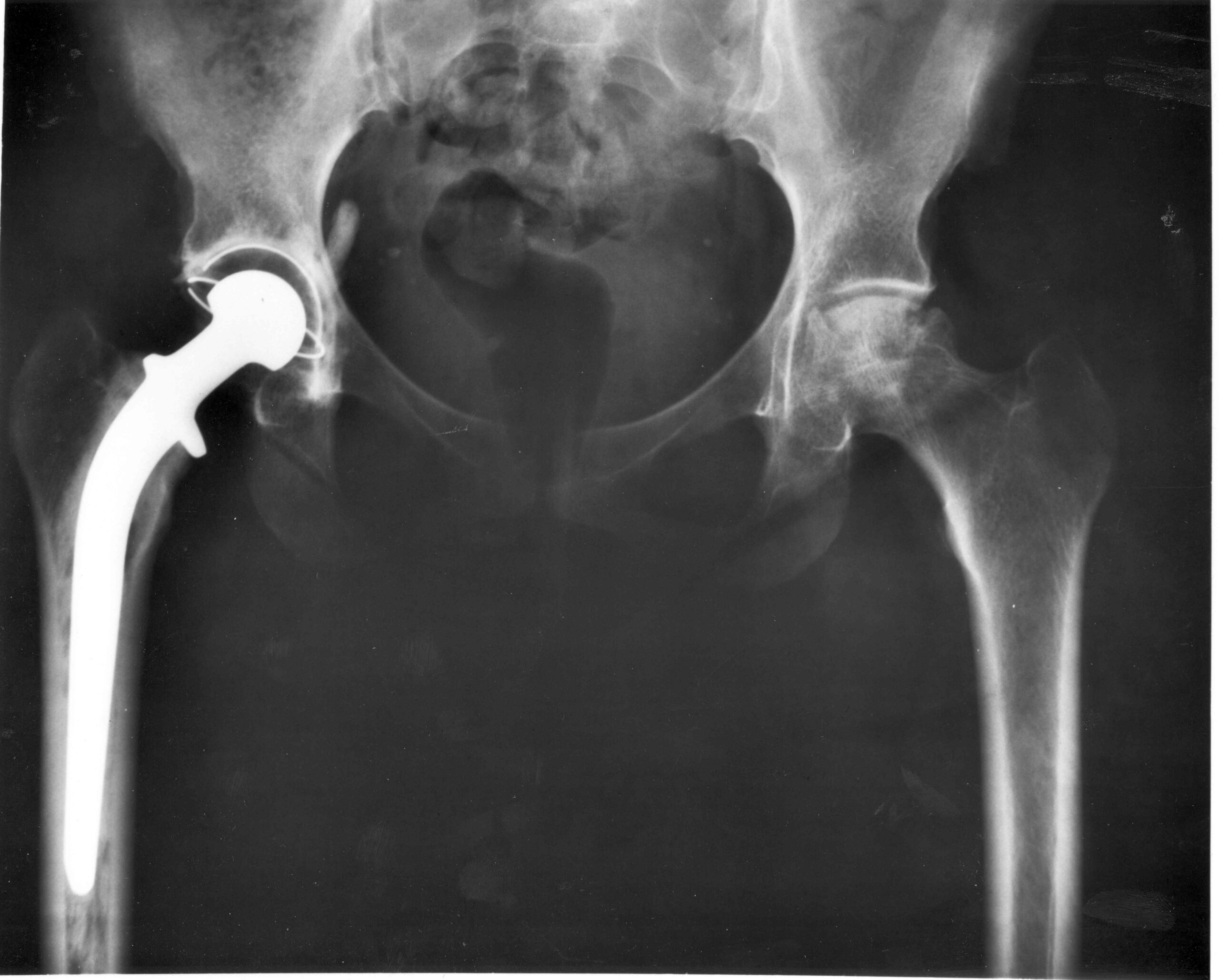 A radiograph showing a total hip joint replacement.