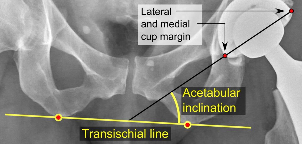 An annotated radiograph of a hip prosthesis showing the acetabular inclination angle