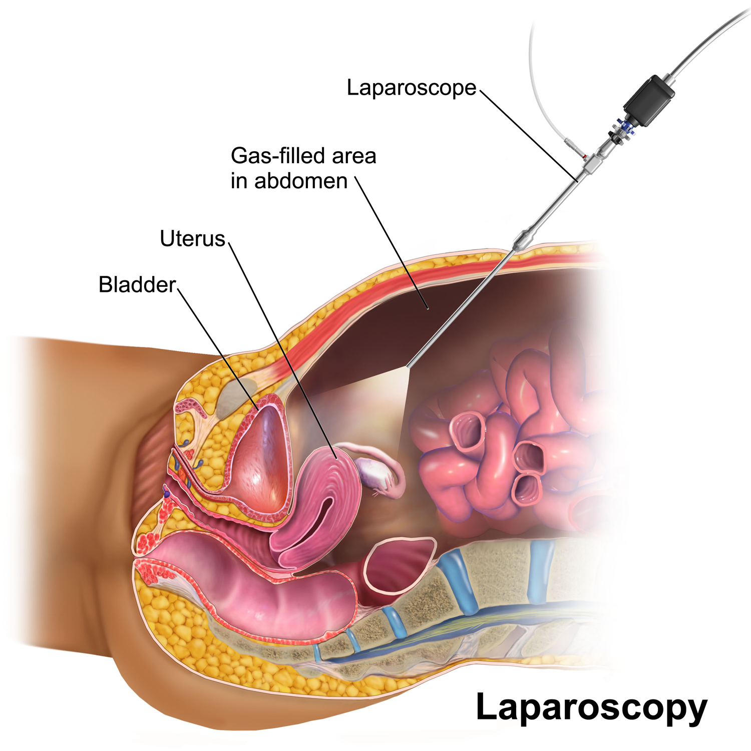 A diagram of laparoscopic access to the abdomen through small ports