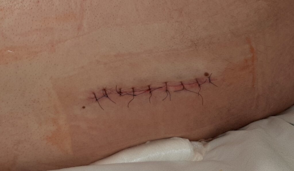 A sutured surgical wound at a post-operative dressing change