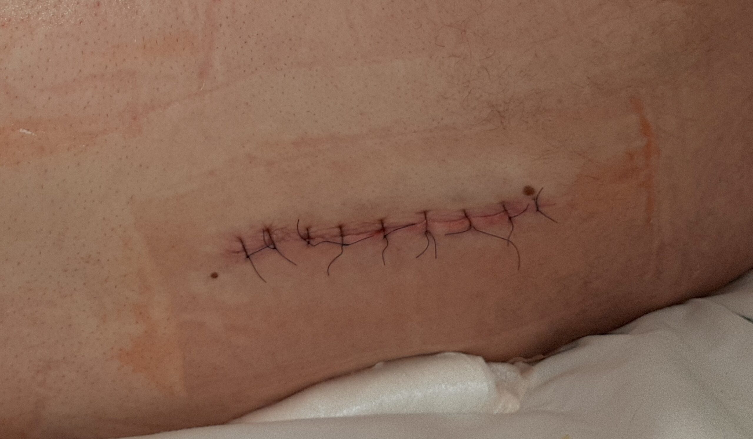 A sutured surgical wound at a post-operative dressing change