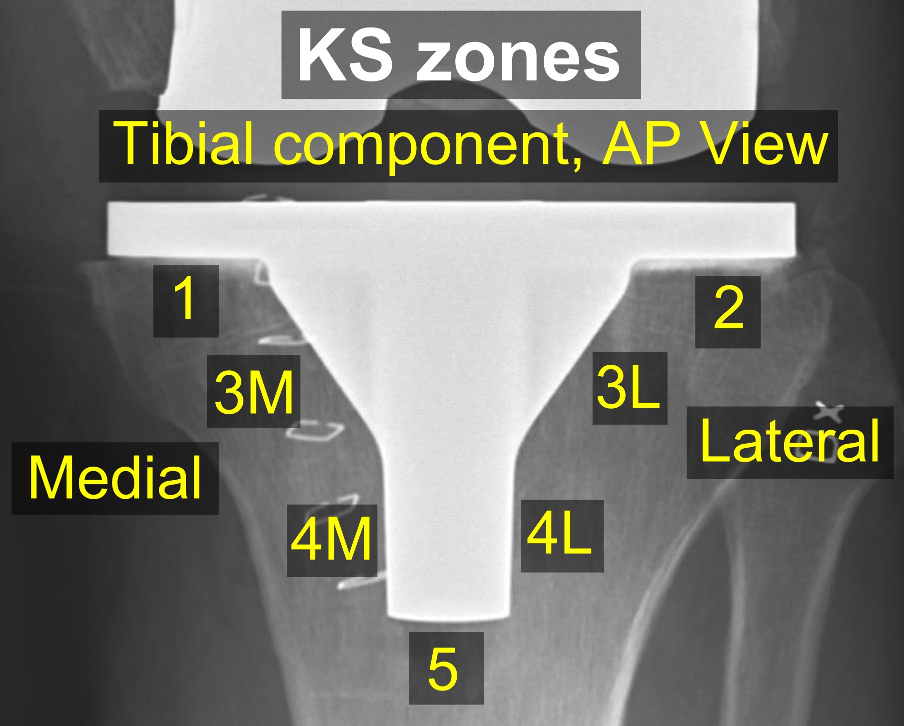 Radiograph of a knee prosthesis after total knee replacement